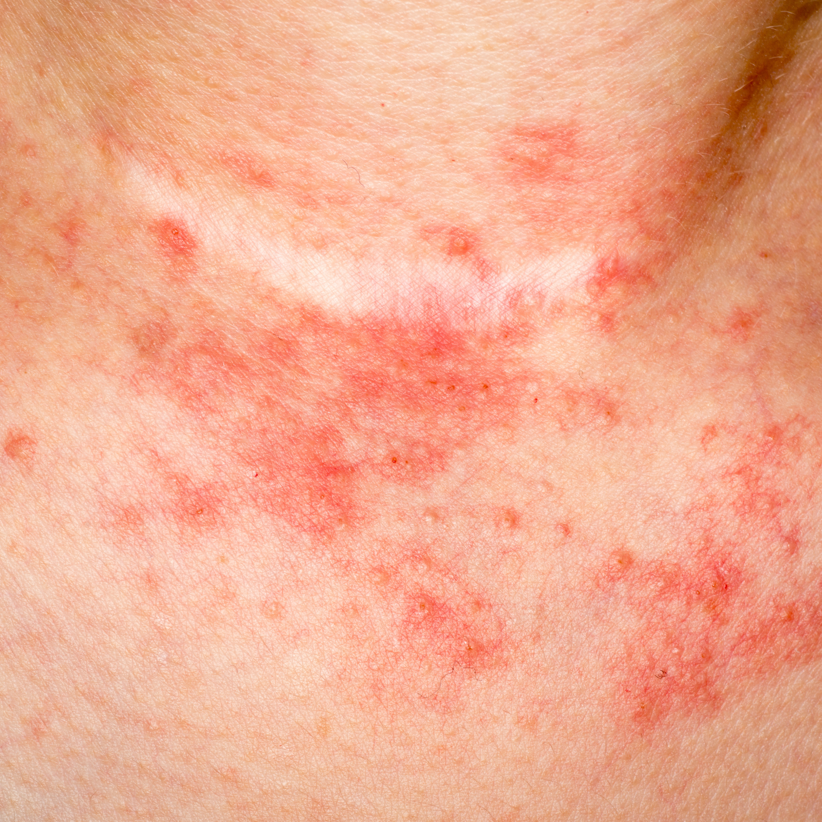 Ozone Therapy Treatment in Puthuppally